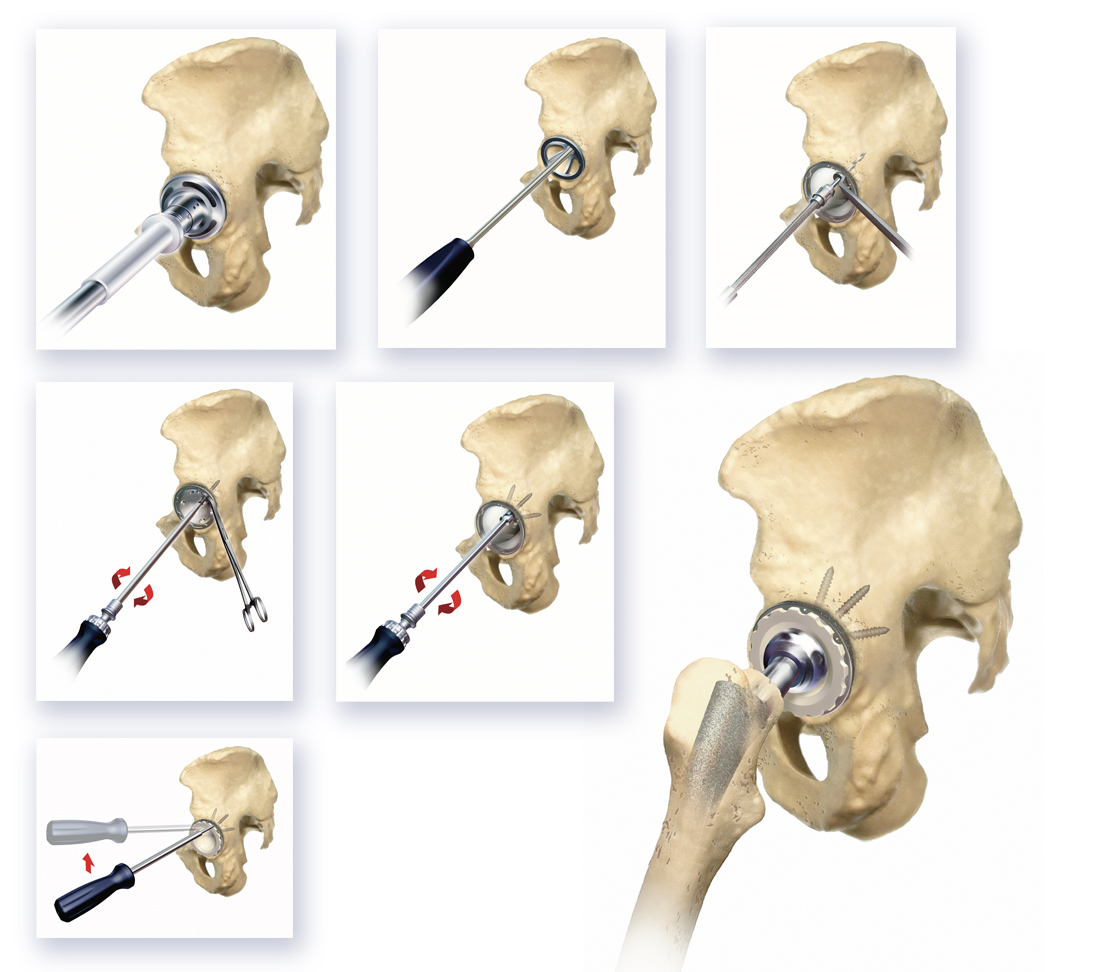 Acetabular hip surgery images