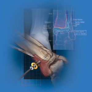 Illustration of ankle fracture repair