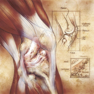 Effects of osteoarthritis on the knee: Scott Holladay