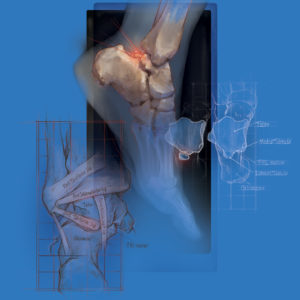 cover illustration of os trigonum surgery