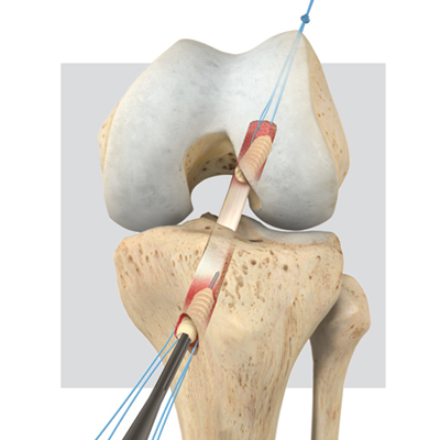 bone-tendon-bone 3D surgical technique